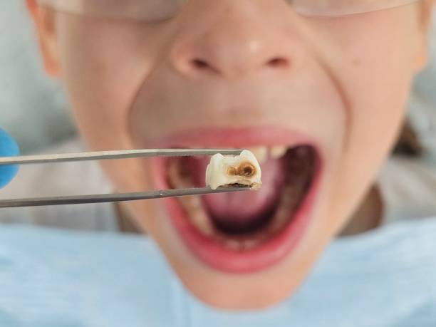 Best Emergency Wisdom Teeth Removal in Ocala, FL